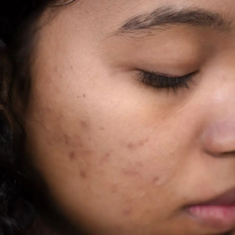 Acne Scars treatment london