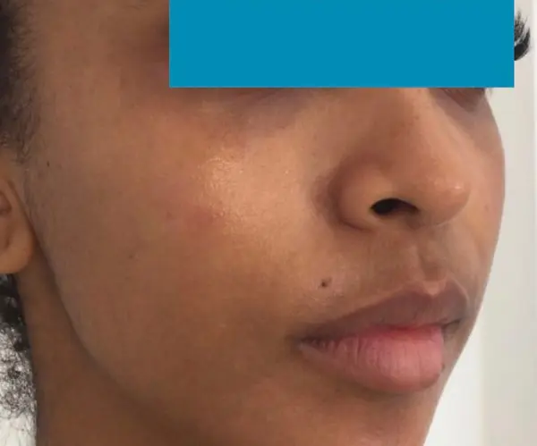 Dermal Filler Treatment after
