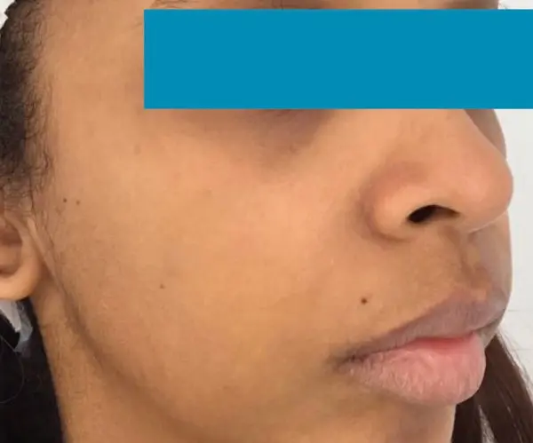 Dermal Filler Treatment before