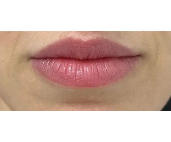 Dermal Filler Treatment after