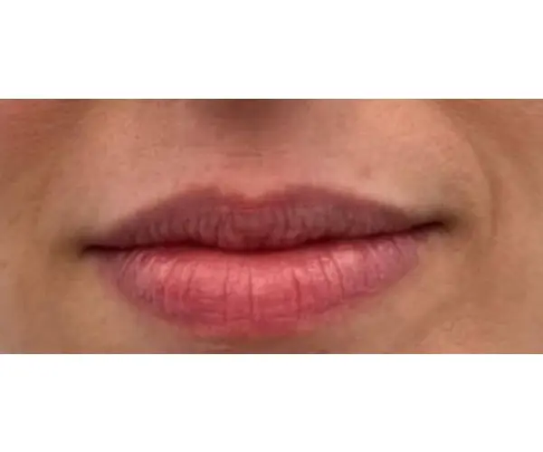 Dermal Filler Treatment before