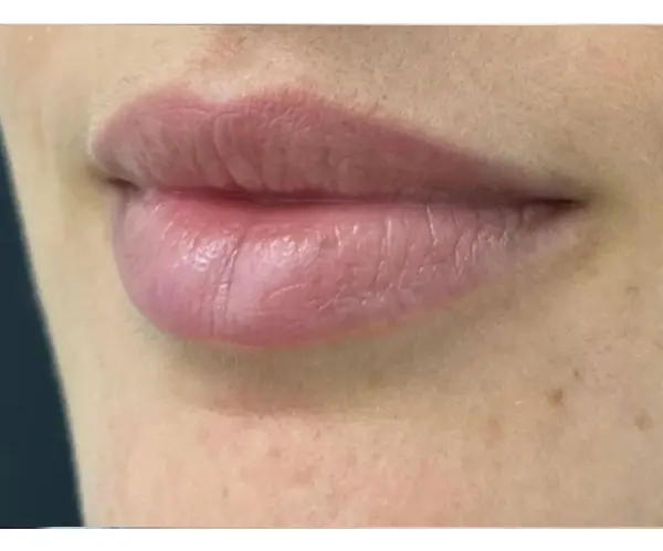 Dermal Filler Treatment after