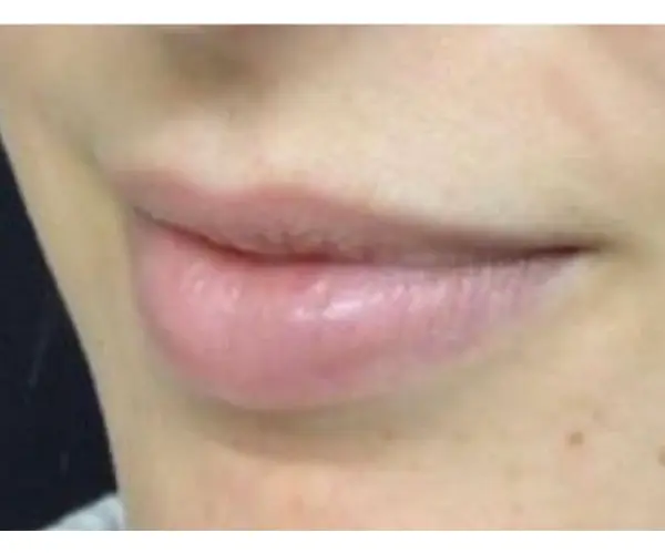 Dermal Filler Treatment before