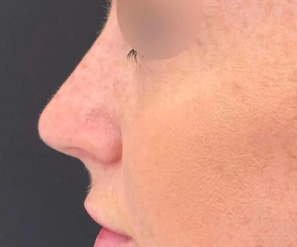 Dermal Filler Treatment after