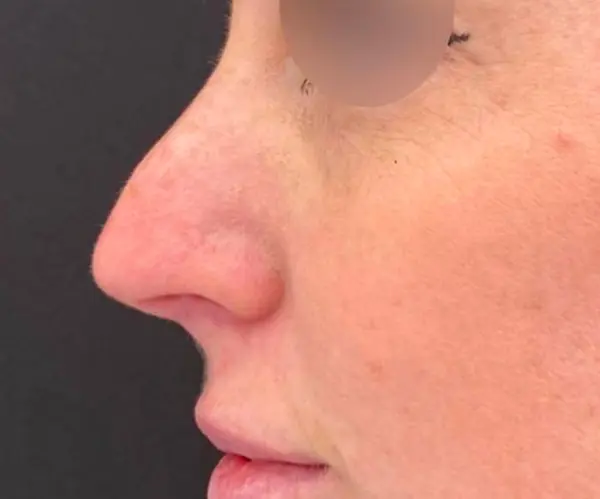 Dermal Filler Treatment before