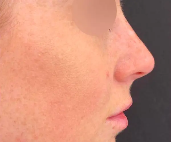 Dermal Filler Treatment after