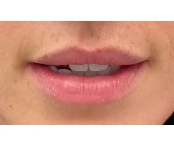 Dissolving lip fillers after