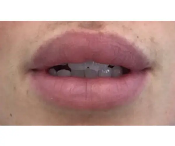 Dissolving lip fillers before