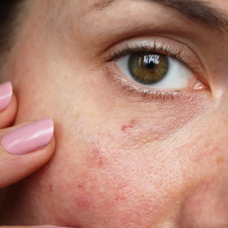Eye Veins