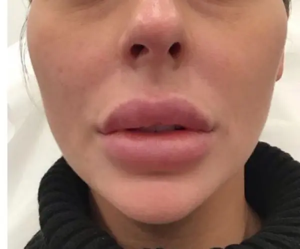 before dissolve lip filler