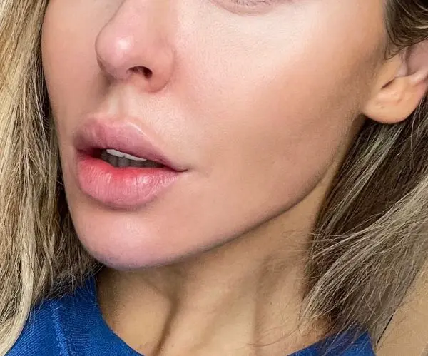 after lip Filler Dissolving in london