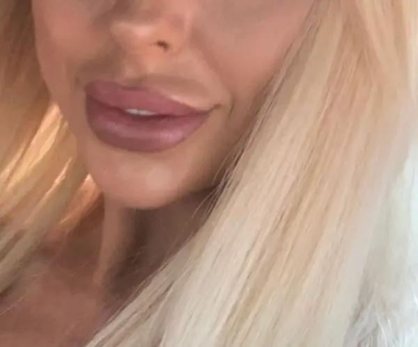 before lip Filler Dissolve in london
