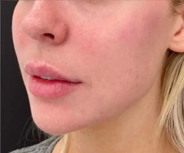 Filler Face Lift after