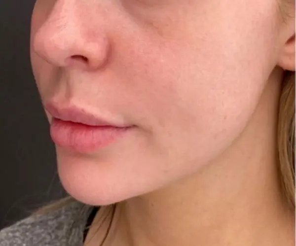 Filler Face Lift before