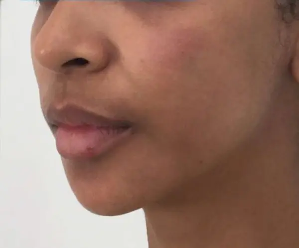 Filler Face Lift after