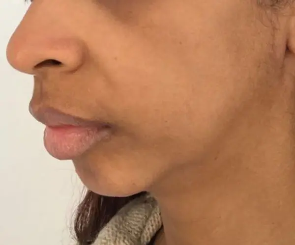 Filler Face Lift before