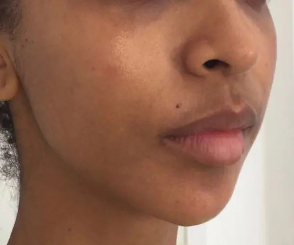 Filler Face Lift after