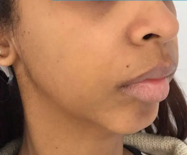 Filler Face Lift before