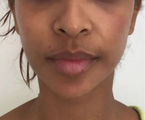 Filler Face Lift after