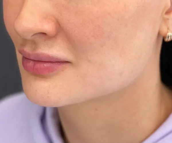 Jawline Fillers
