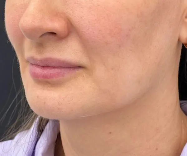 Jawline Fillers
