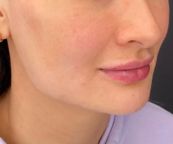 Jawline Fillers