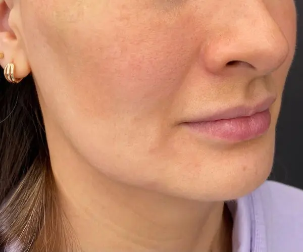Jawline Fillers