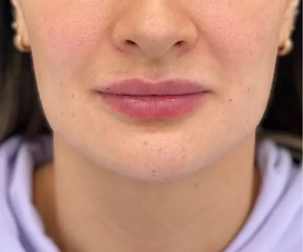 Jawline Fillers