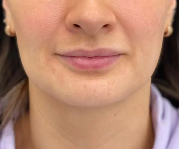 Jawline Fillers