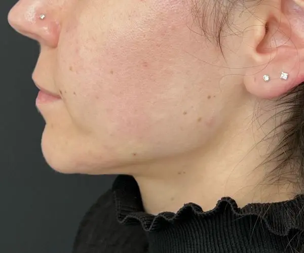 Jawline Fillers