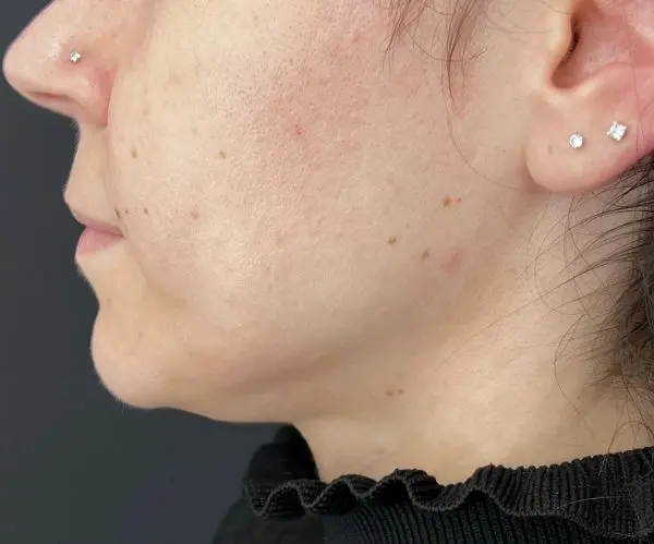 Jawline Fillers