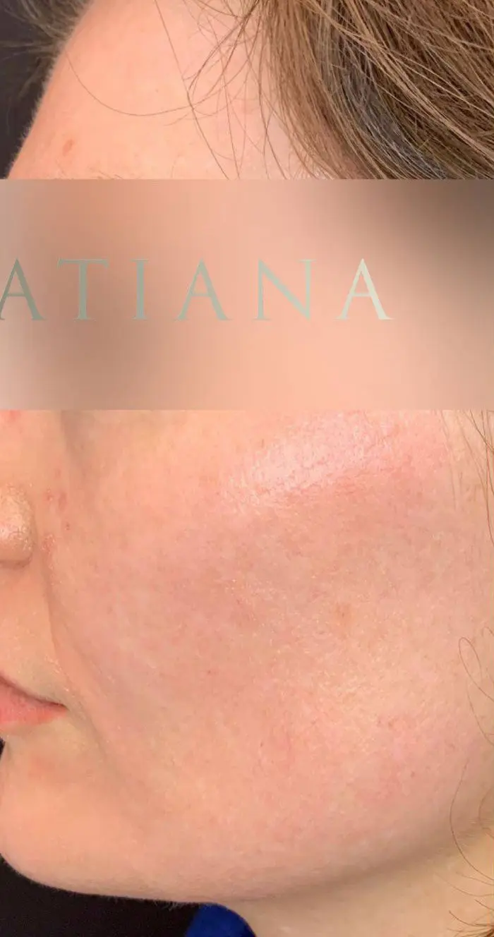 after Laser Hyperpigmentation Treatment