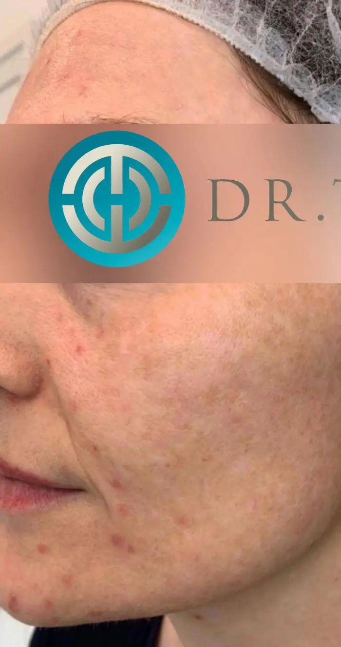 before Laser Hyperpigmentation Treatment
