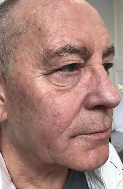 Laser Skin Treatments