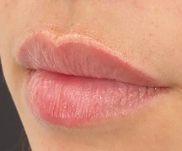 Lips filler london after