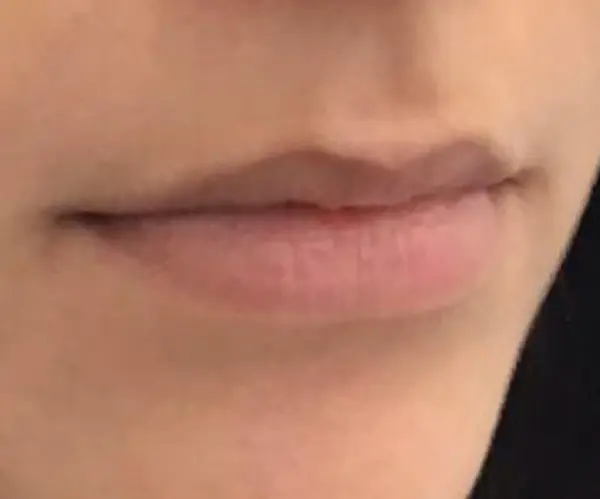 Lips before