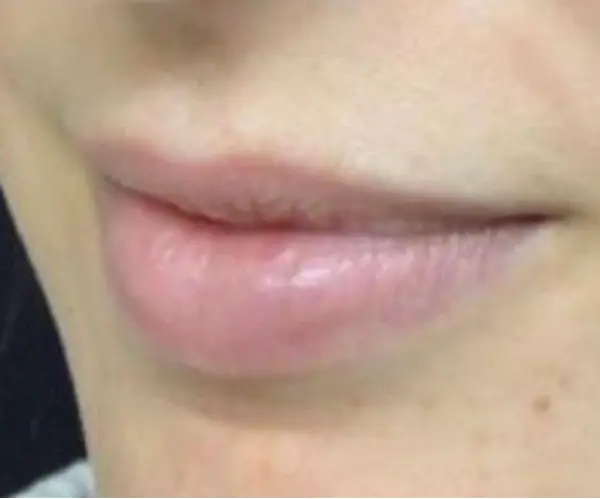 Lips before