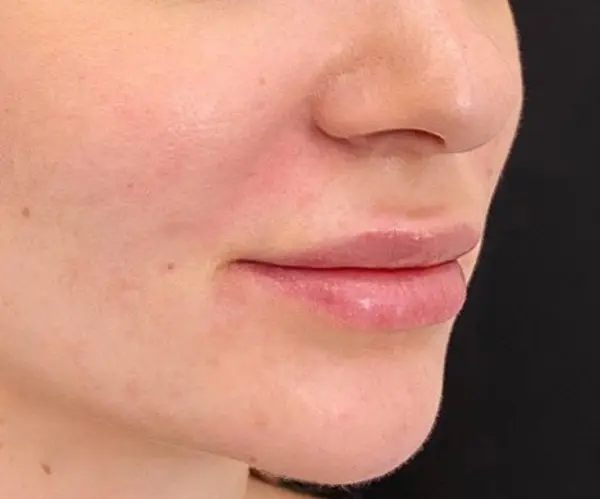 Marionette Lines after