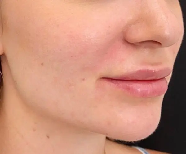 Nasolabial Folds