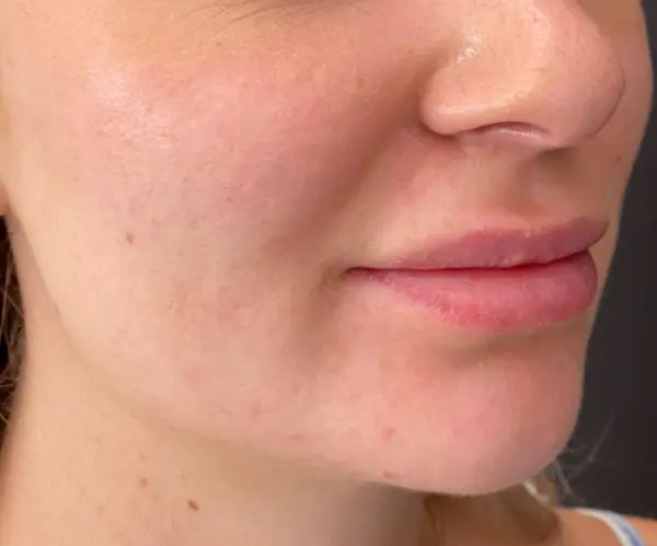 Nasolabial Folds
