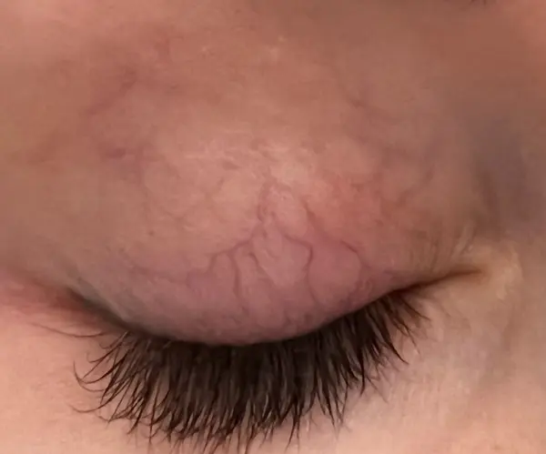 Laser Thread Vein Treatment after