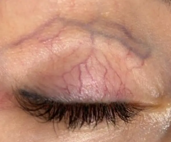 Laser Thread Vein Treatment eye before