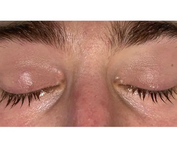 Laser Thread Vein Treatment after
