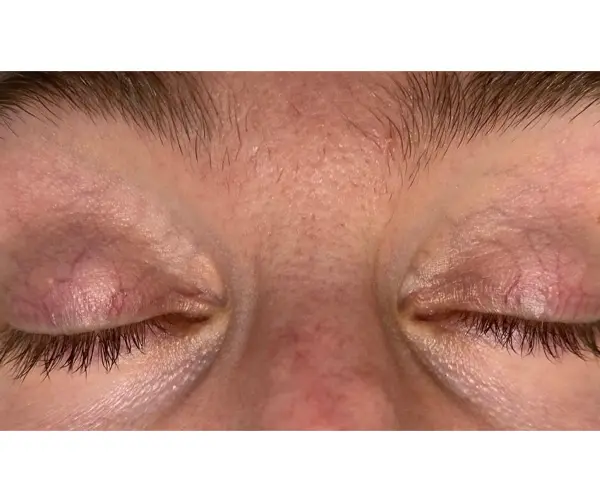 Laser Thread Vein Treatment before