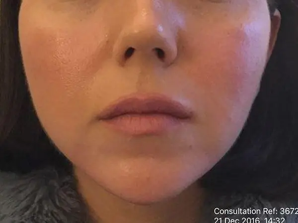 Dermal Fillers - Chin - After 02