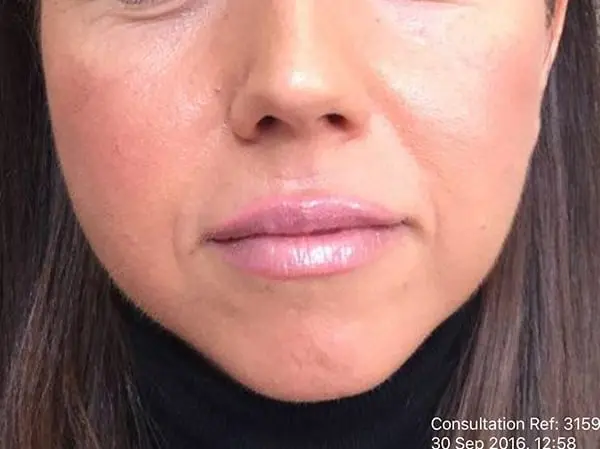 Dermal Fillers - Chin - Before 02