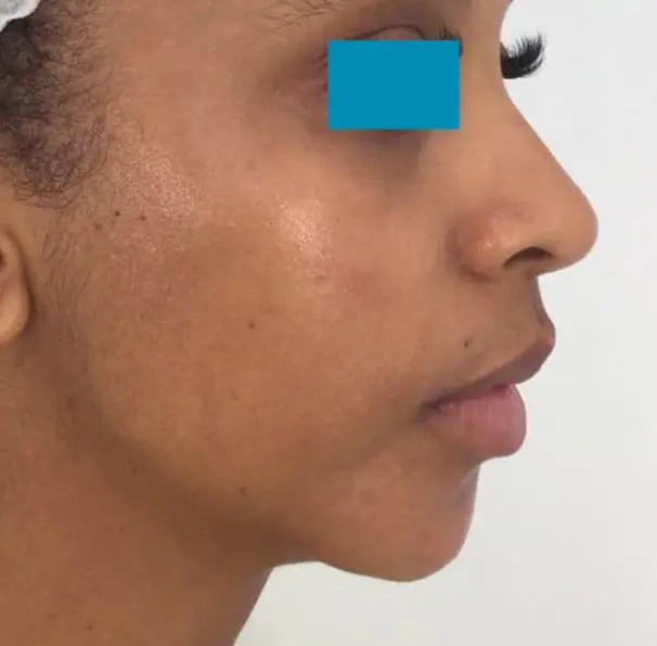 Dermal Fillers - Chin - After 04