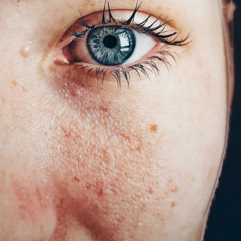 Oily Skin treatment