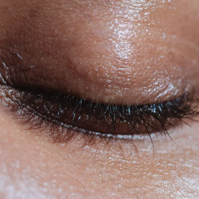 dark circles treatment london