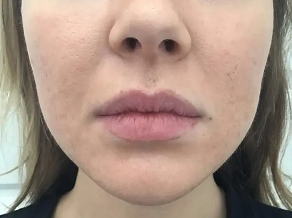 Dermal Filler Dissolving - After 01